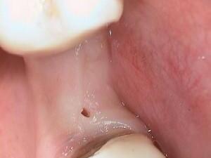 implantaten_bovens_01.jpg
