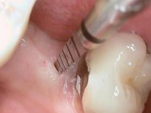 implantaten_bovens_02.jpg