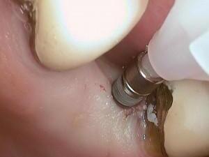 implantaten_bovens_03.jpg