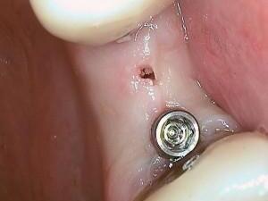 implantaten_bovens_04.jpg