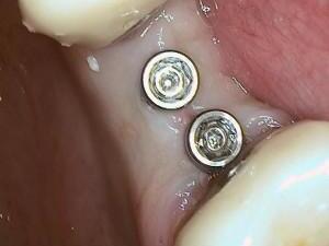 implantaten_bovens_05.jpg